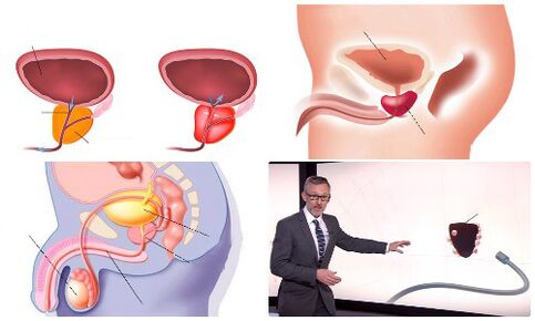 prostata osasuntsua eta gaixoa